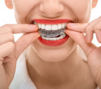 5 Consejos para que tu sonrisa brille en Carnaval